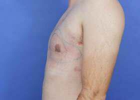 Gynecomastia Surgery Before & After Image