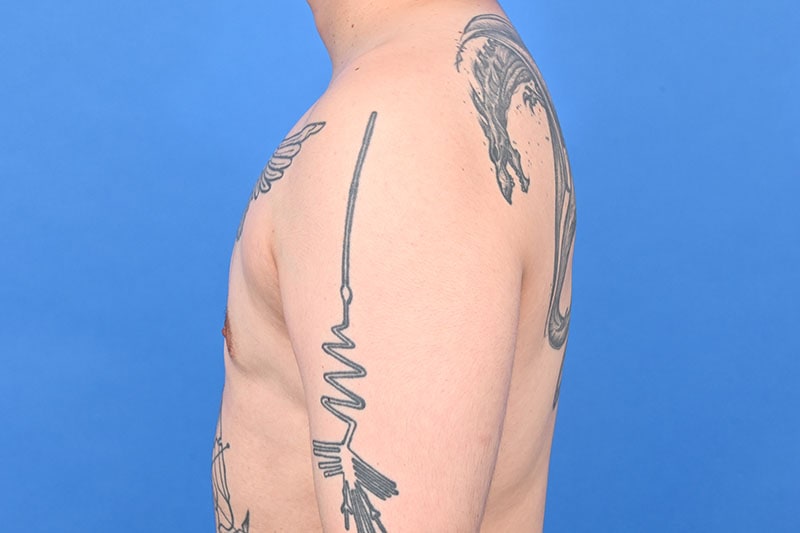 Gynecomastia Surgery Before & After Image