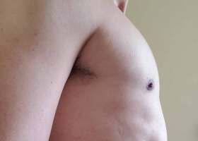 Gynecomastia Surgery Before & After Image