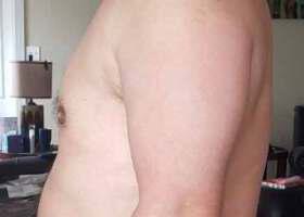 Gynecomastia Surgery Before & After Image