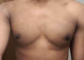 Gynecomastia Surgery Before & After Image