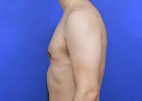 Gynecomastia Surgery Before & After Image