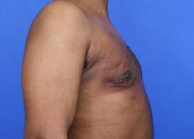 Gynecomastia Surgery Before & After Image