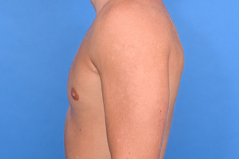 Gynecomastia Surgery Before & After Image