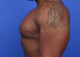 Gynecomastia Surgery Before & After Image