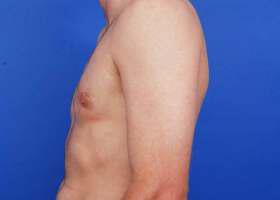 Gynecomastia Surgery Before & After Image
