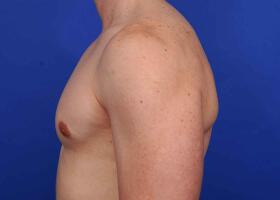 Gynecomastia Surgery Before & After Image