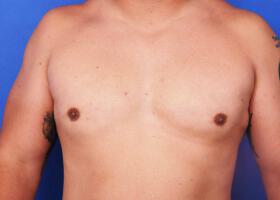 Gynecomastia Surgery Before & After Image