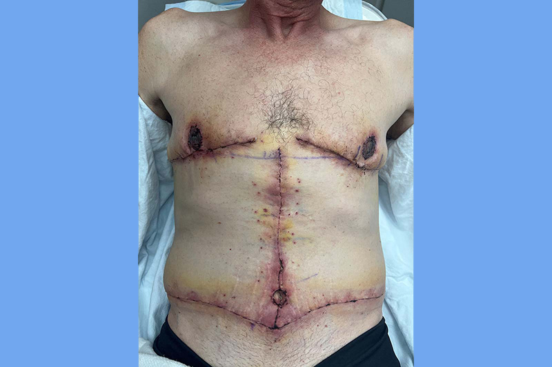 Gynecomastia Surgery Before & After Image