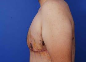 Gynecomastia Surgery Before & After Image