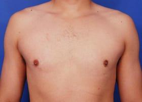 Gynecomastia Surgery Before & After Image