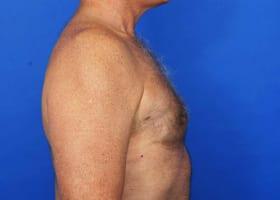 Gynecomastia Surgery Before & After Image
