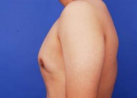 Gynecomastia Surgery Before & After Image