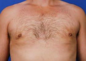 Gynecomastia Surgery Before & After Image