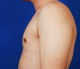 Gynecomastia Surgery Before & After Image