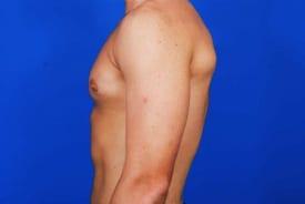 Gynecomastia Surgery Before & After Image