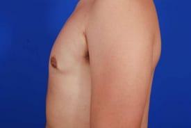 Gynecomastia Surgery Before & After Image