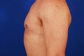 Gynecomastia Surgery Before & After Image