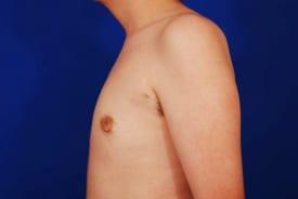 Gynecomastia Surgery Before & After Image