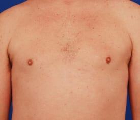 Gynecomastia Surgery Before & After Image