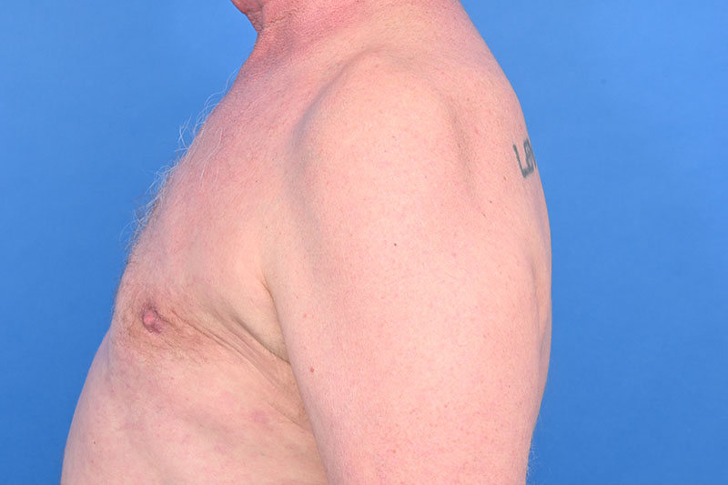 Gynecomastia Surgery Before & After Image