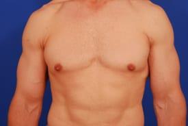 Gynecomastia Surgery Before & After Image