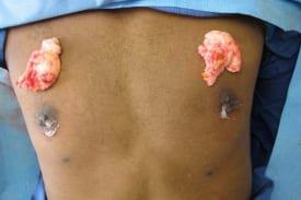 Gynecomastia Surgery Before & After Image