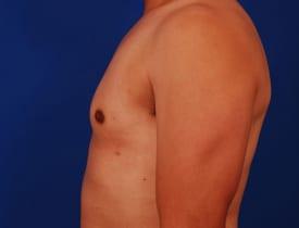 Gynecomastia Surgery Before & After Image
