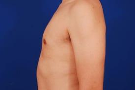 Gynecomastia Surgery Before & After Image