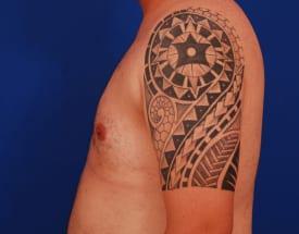 Gynecomastia Surgery Before & After Image