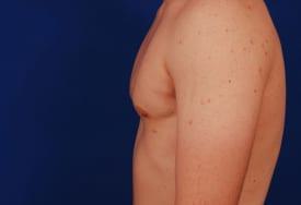 Gynecomastia Surgery Before & After Image