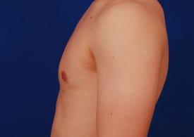 Gynecomastia Surgery Before & After Image
