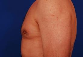 Gynecomastia Surgery Before & After Image