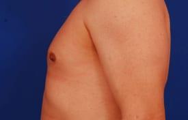 Gynecomastia Surgery Before & After Image