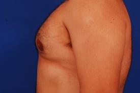 Gynecomastia Surgery Before & After Image