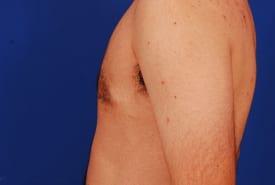 Gynecomastia Surgery Before & After Image
