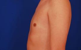 Gynecomastia Surgery Before & After Image