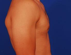 Gynecomastia Surgery Before & After Image
