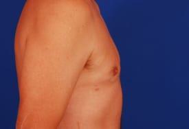 Gynecomastia Surgery Before & After Image