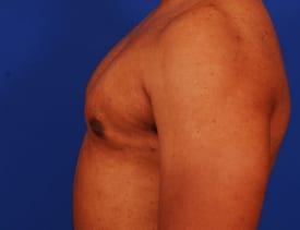 Gynecomastia Surgery Before & After Image