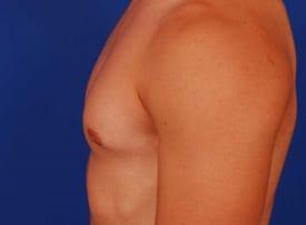 Gynecomastia Surgery Before & After Image