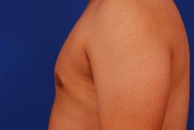 Gynecomastia Surgery Before & After Image