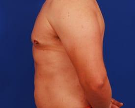Gynecomastia Surgery Before & After Image