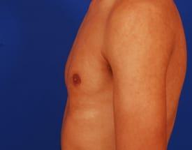Gynecomastia Surgery Before & After Image