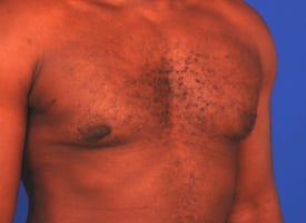 Gynecomastia Surgery Before & After Image