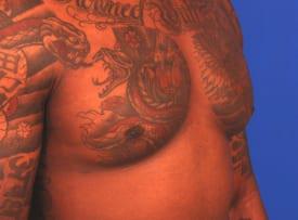 Gynecomastia Surgery Before & After Image