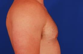 Gynecomastia Surgery Before & After Image