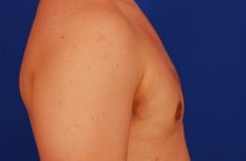 Gynecomastia Surgery Before & After Image