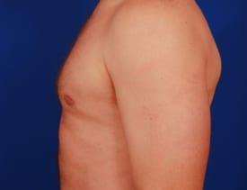 Gynecomastia Surgery Before & After Image