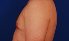 Gynecomastia Surgery Before & After Image